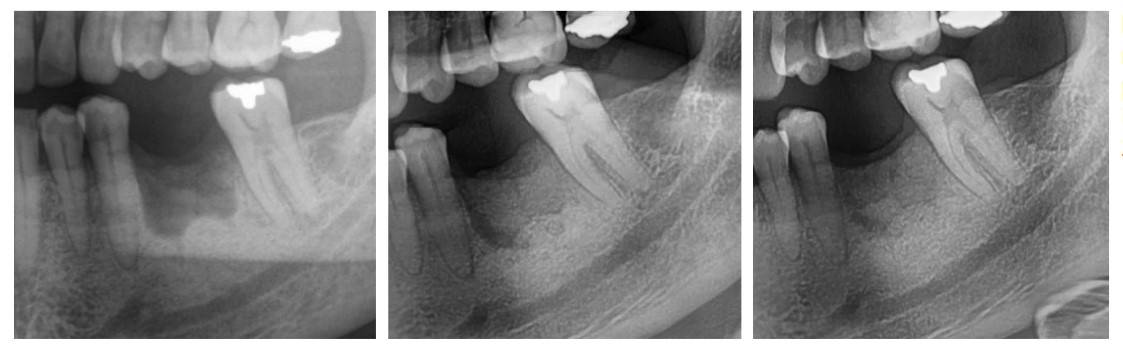 Bone graft 1